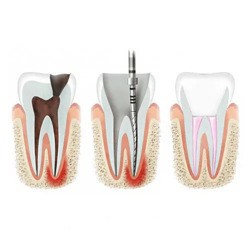 Endodoncia